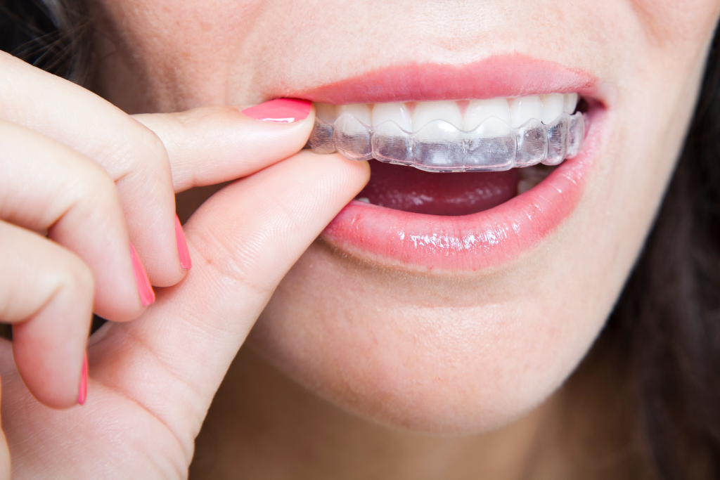 woman-placing-clear-aligner-tray-over-upper-teeth-as-part-of-orthodontic-treatment-in-singapore