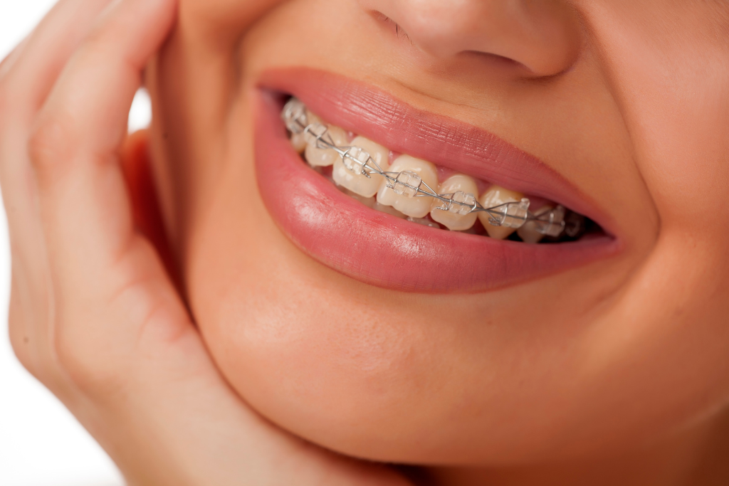 close-up-of-woman-smiling-with-clear-braces-showing-discreet-fixed-orthodontic-option-in-singapore